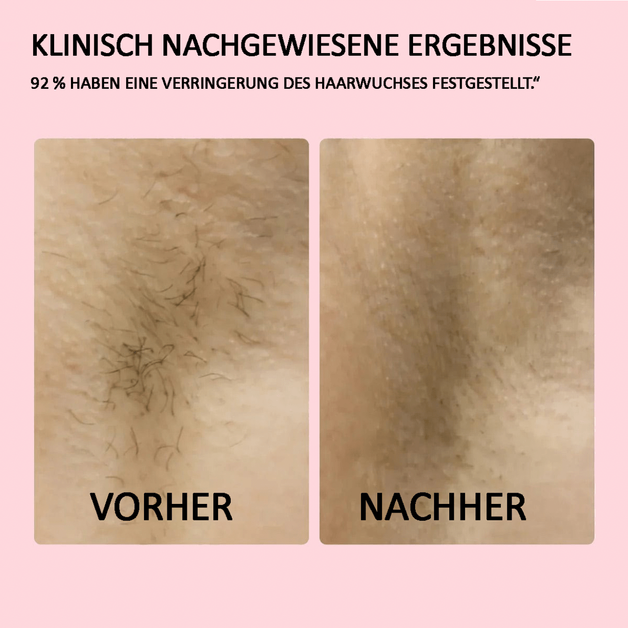 Lumea Epi •IPL-Haarentfernungsgerät