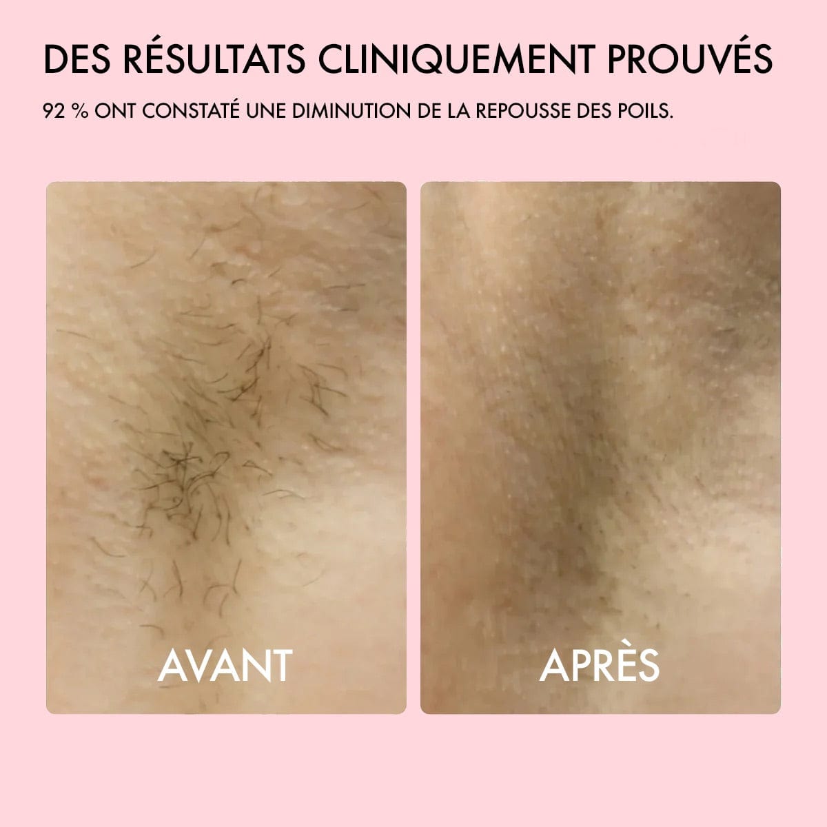 Lumea Epi • Épilateur à Lumière Pulsée  •