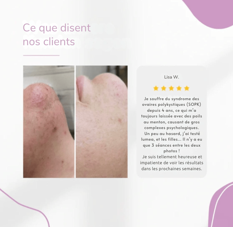 Lumea Epi • Épilateur à Lumière Pulsée  •